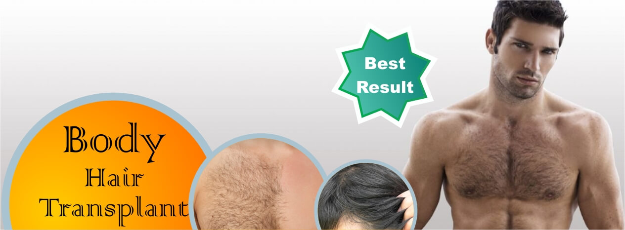 FUE Hair Transplant