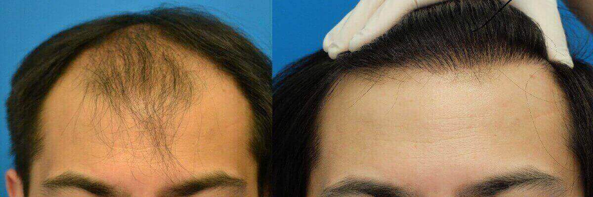 Hair line Recreation