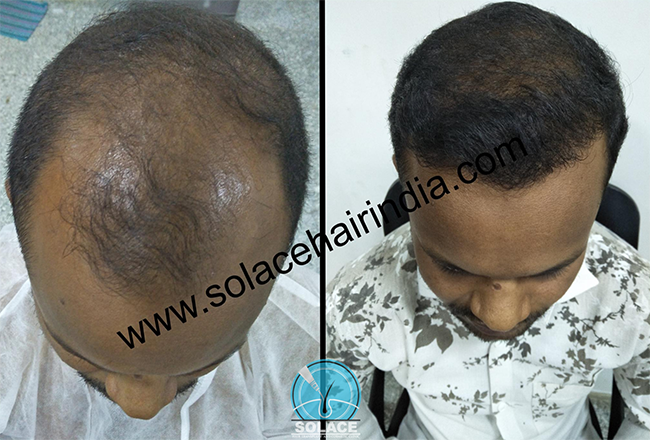 hair transplant patient with best hair transplant results