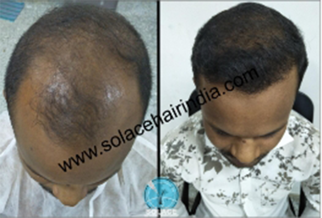 hair transplant patient with best hair transplant results