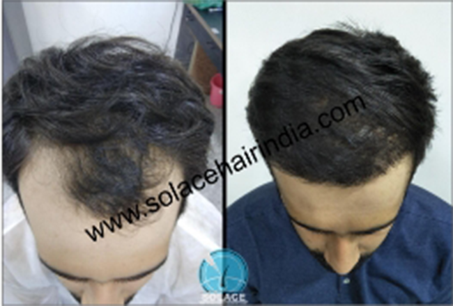 hair transplant patient with best hair transplant results