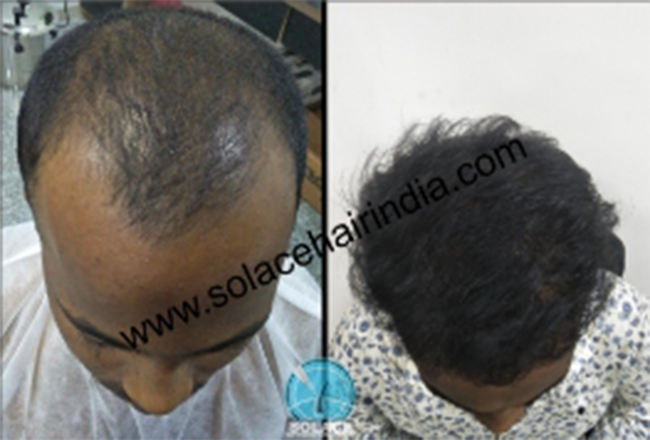 hair transplant patient with best hair transplant results