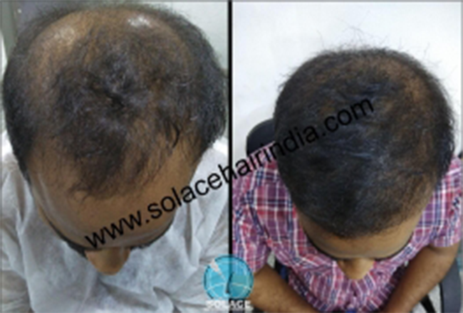 hair transplant patient with best hair transplant results