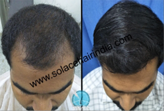 hair transplant patient with best hair transplant results