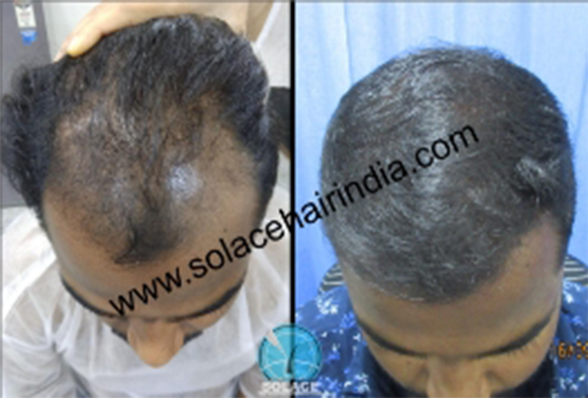 hair transplant patient with best hair transplant results