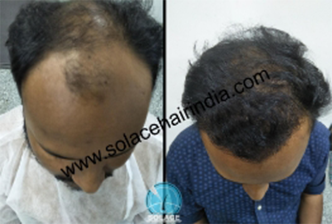 hair transplant patient with best hair transplant results