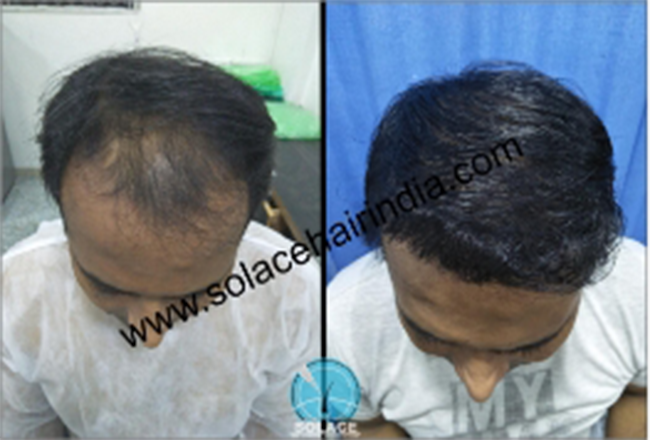 hair transplant patient with best hair transplant results