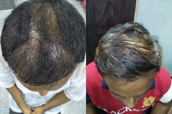 hair transplant result