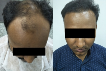 hair transplant result